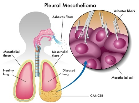 mesothelioma 10 year survival rate